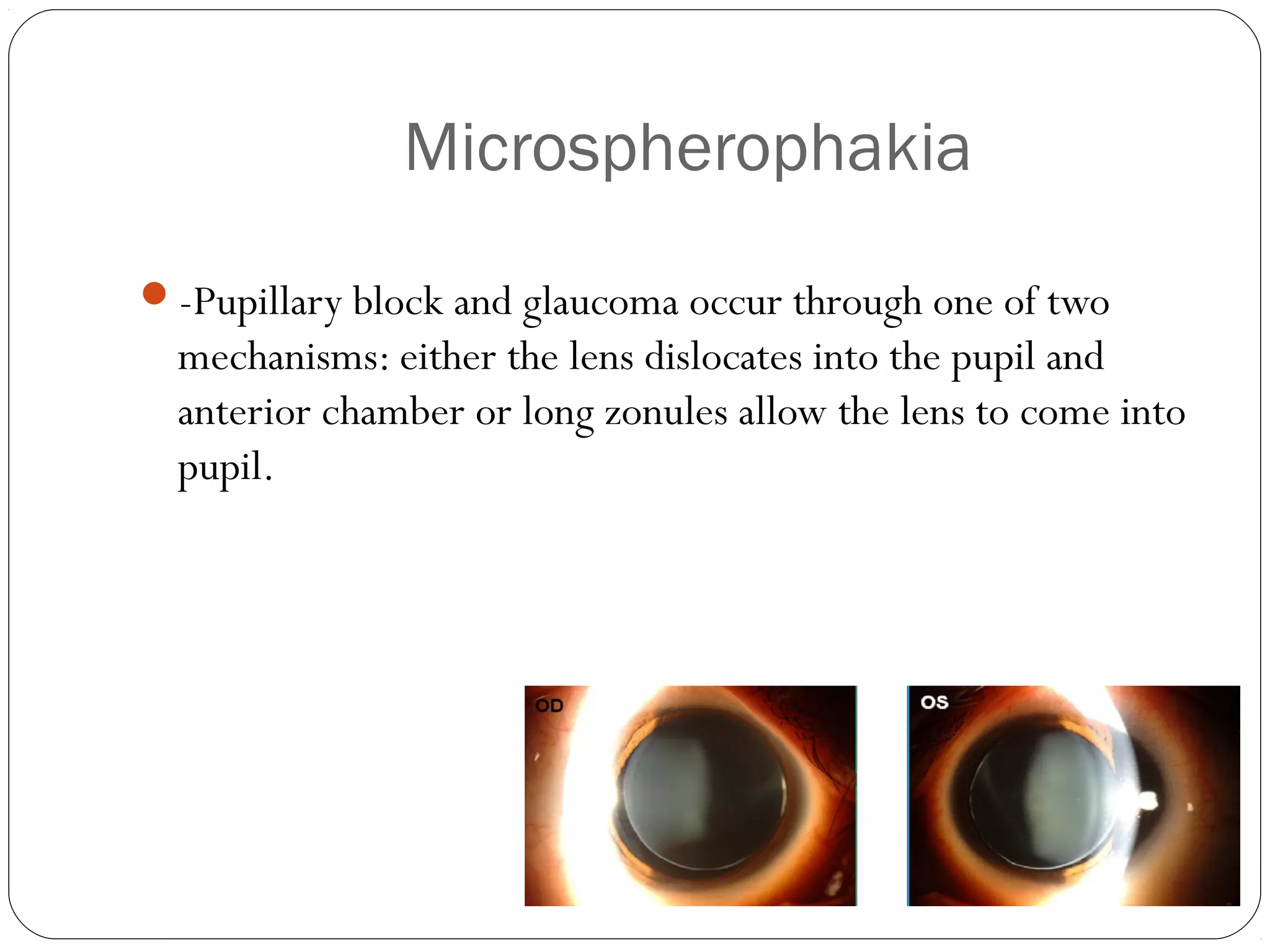 Microspherophakia
-Pupillary block and glaucoma occur through one of two
mechanisms: either the lens dislocates into the pupil and
anterior chamber or long zonules allow the lens to come into
pupil.
 