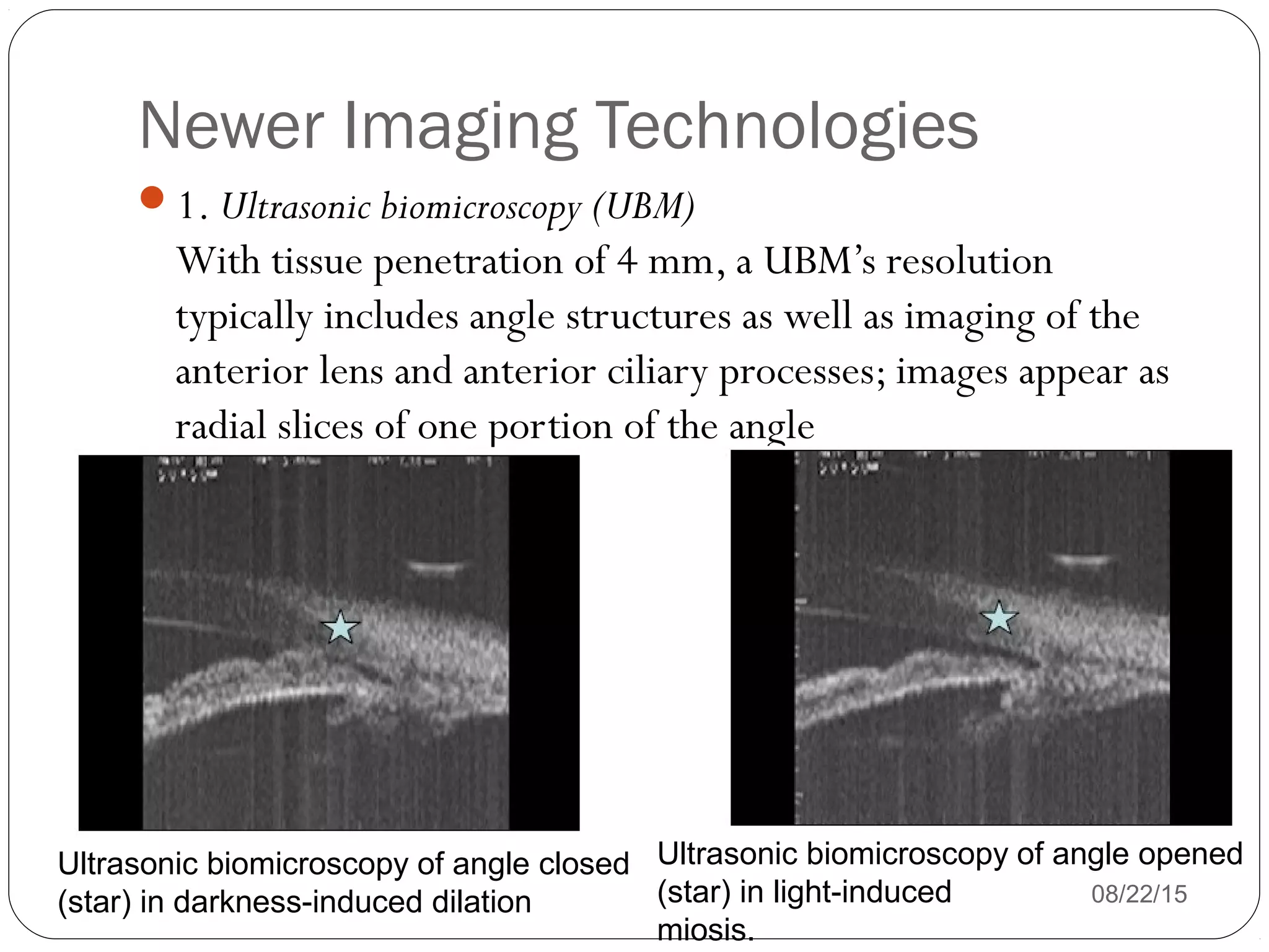Newer Imaging Technologies
08/22/15
1. Ultrasonic biomicroscopy (UBM)
With tissue penetration of 4 mm, a UBM’s resolution
typically includes angle structures as well as imaging of the
anterior lens and anterior ciliary processes; images appear as
radial slices of one portion of the angle
Ultrasonic biomicroscopy of angle closed
(star) in darkness-induced dilation
Ultrasonic biomicroscopy of angle opened
(star) in light-induced
miosis.
 