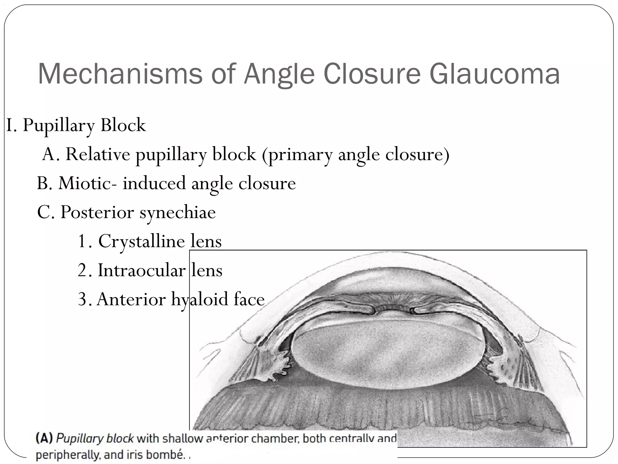 Mechanisms of Angle Closure Glaucoma
I. Pupillary Block
A. Relative pupillary block (primary angle closure)
B. Miotic- induced angle closure
C. Posterior synechiae
1. Crystalline lens
2. Intraocular lens
3.Anterior hyaloid face
 