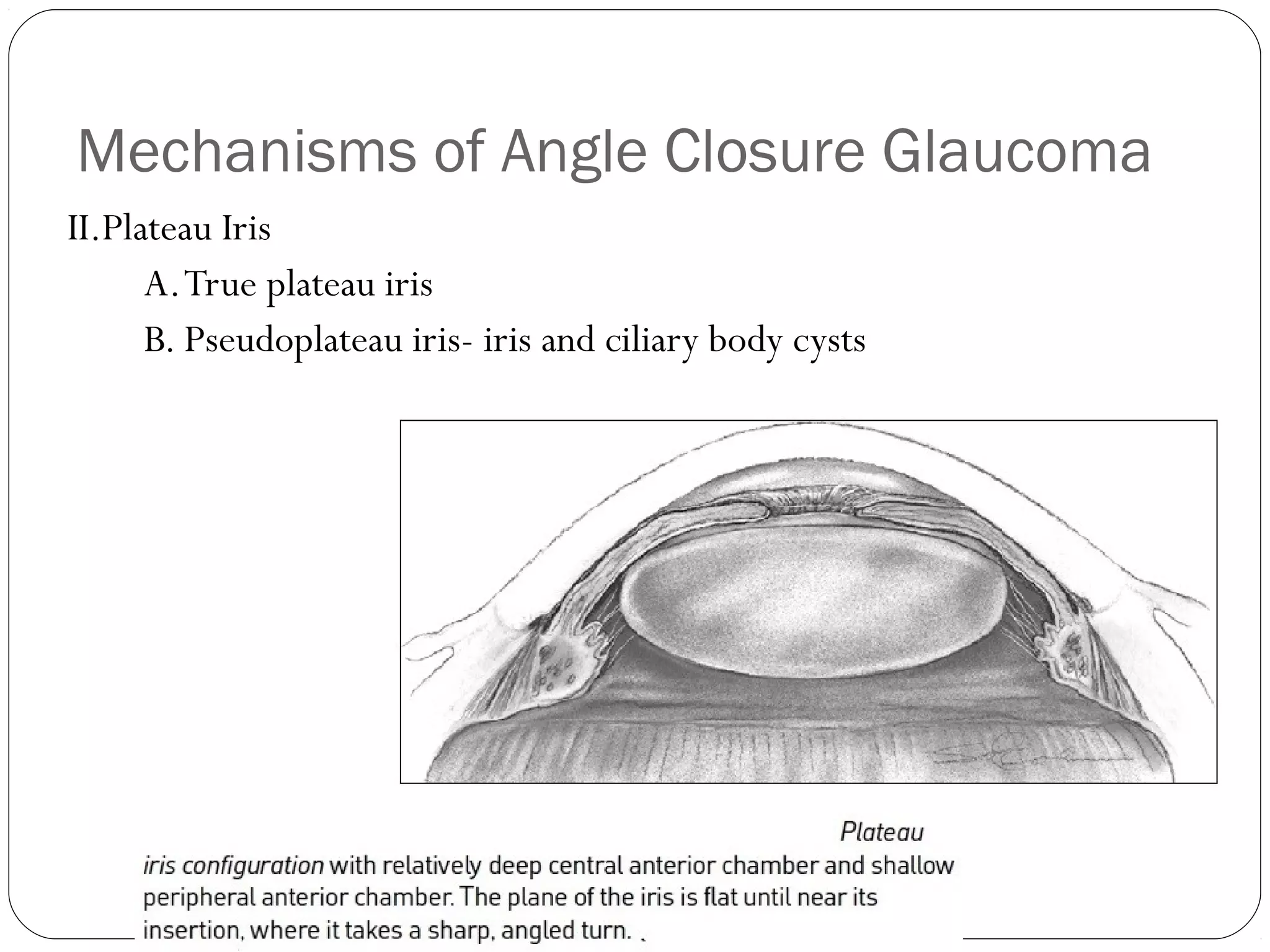 Mechanisms of Angle Closure Glaucoma
II.Plateau Iris
A.True plateau iris
B. Pseudoplateau iris- iris and ciliary body cysts
 