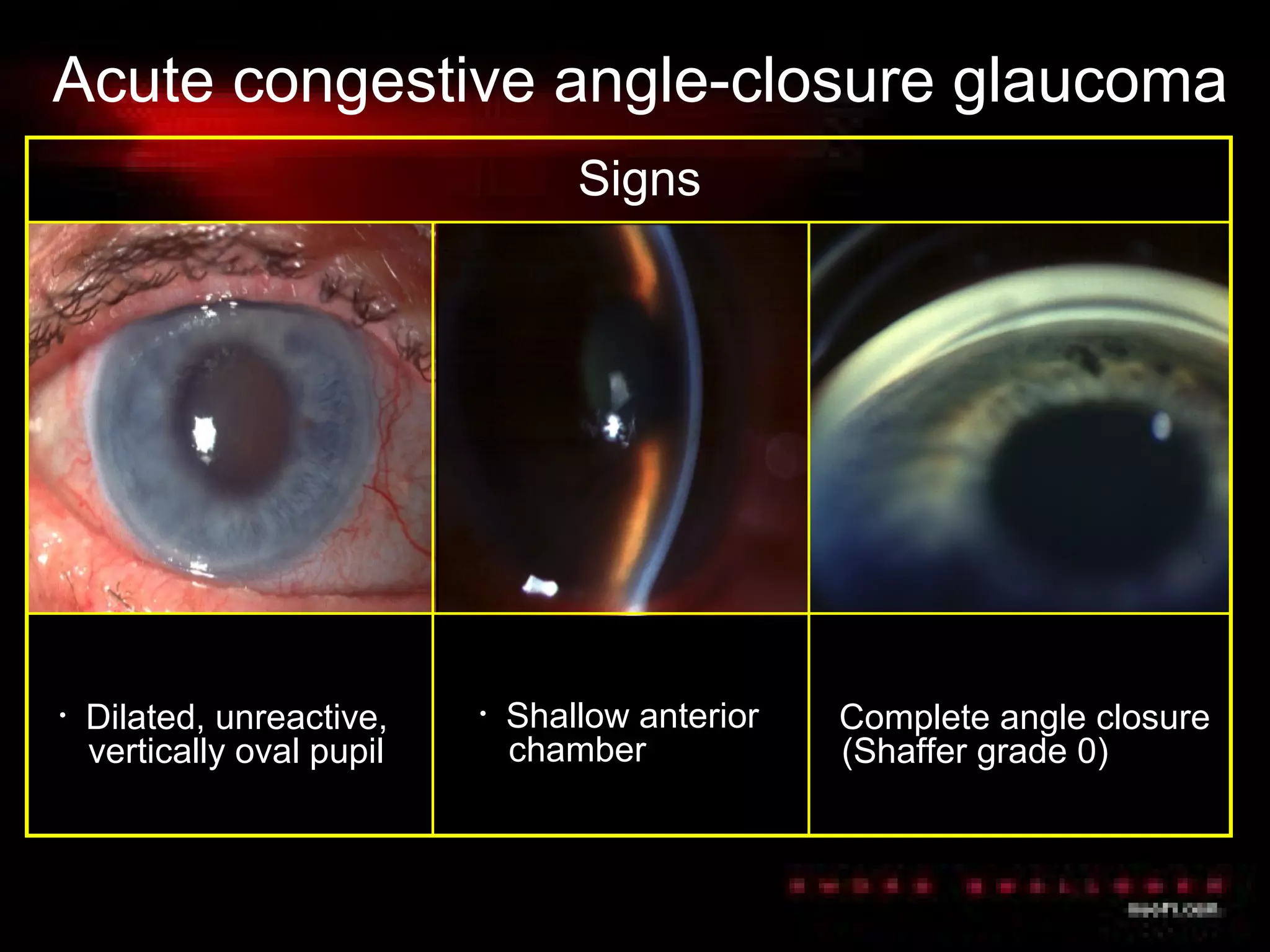 Acute congestive angle-closure glaucoma
• Severe corneal oedema
• Complete angle closure
(Shaffer grade 0)
• Dilated, unreactive,
vertically oval pupil
• Shallow anterior
chamber
• Ciliary injection
Signs
 