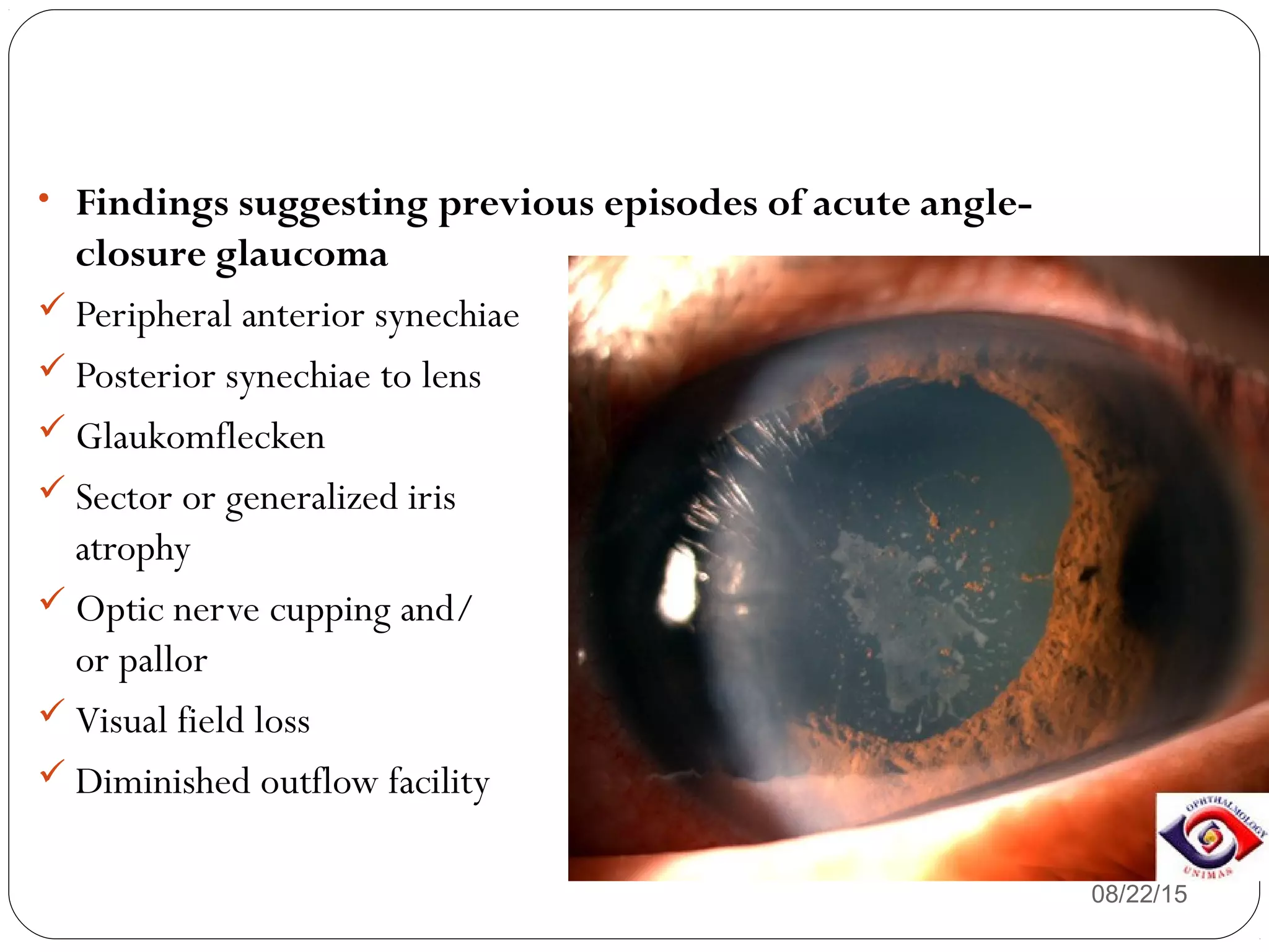 08/22/15
• Findings suggesting previous episodes of acute angle-
closure glaucoma
 Peripheral anterior synechiae
 Posterior synechiae to lens
 Glaukomflecken
 Sector or generalized iris
atrophy
 Optic nerve cupping and/
or pallor
 Visual field loss
 Diminished outflow facility
 