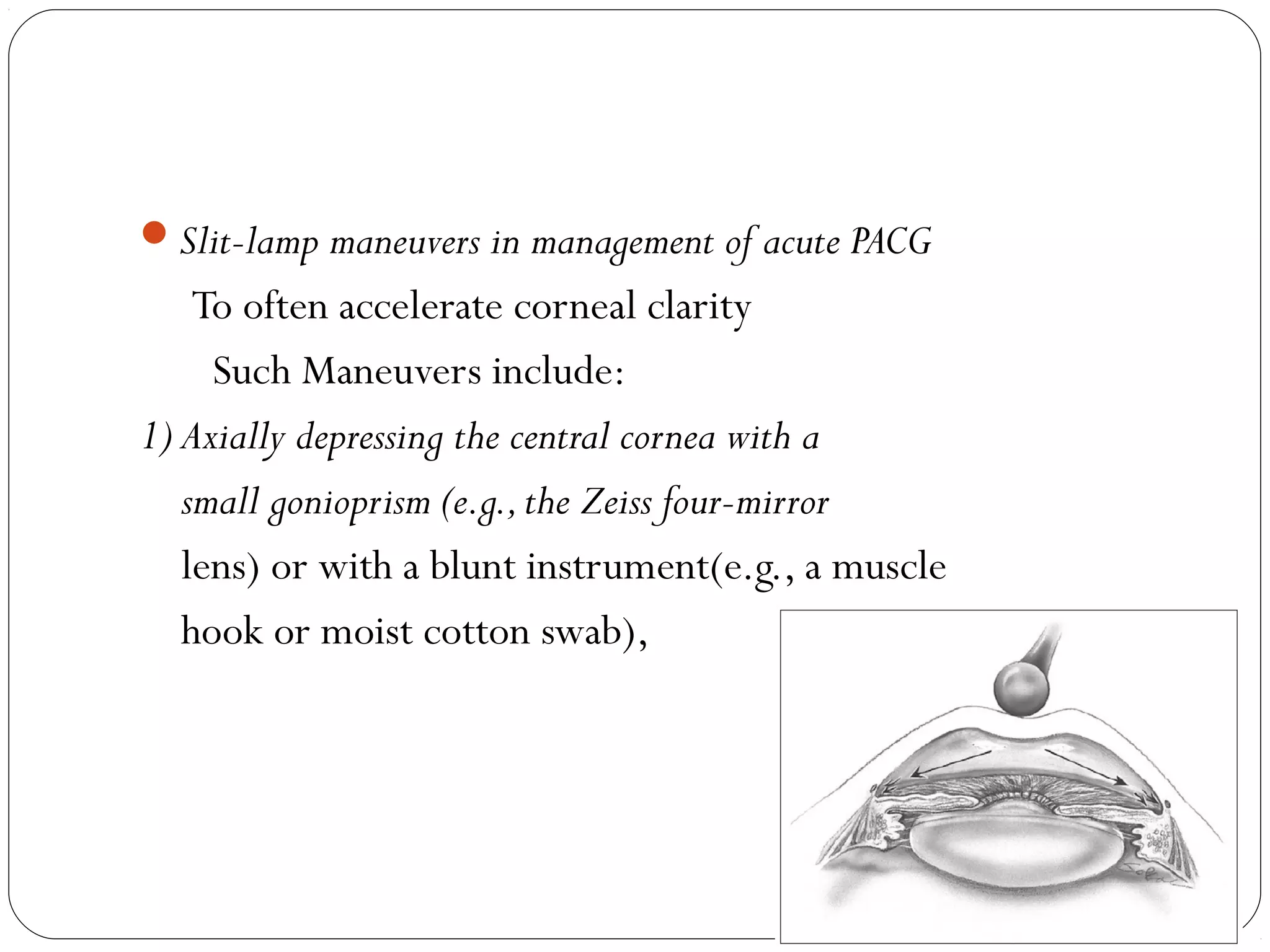 Slit-lamp maneuvers in management of acute PACG
To often accelerate corneal clarity
Such Maneuvers include:
1) Axially depressing the central cornea with a
small gonioprism (e.g.,the Zeiss four-mirror
lens) or with a blunt instrument(e.g., a muscle
hook or moist cotton swab),
 