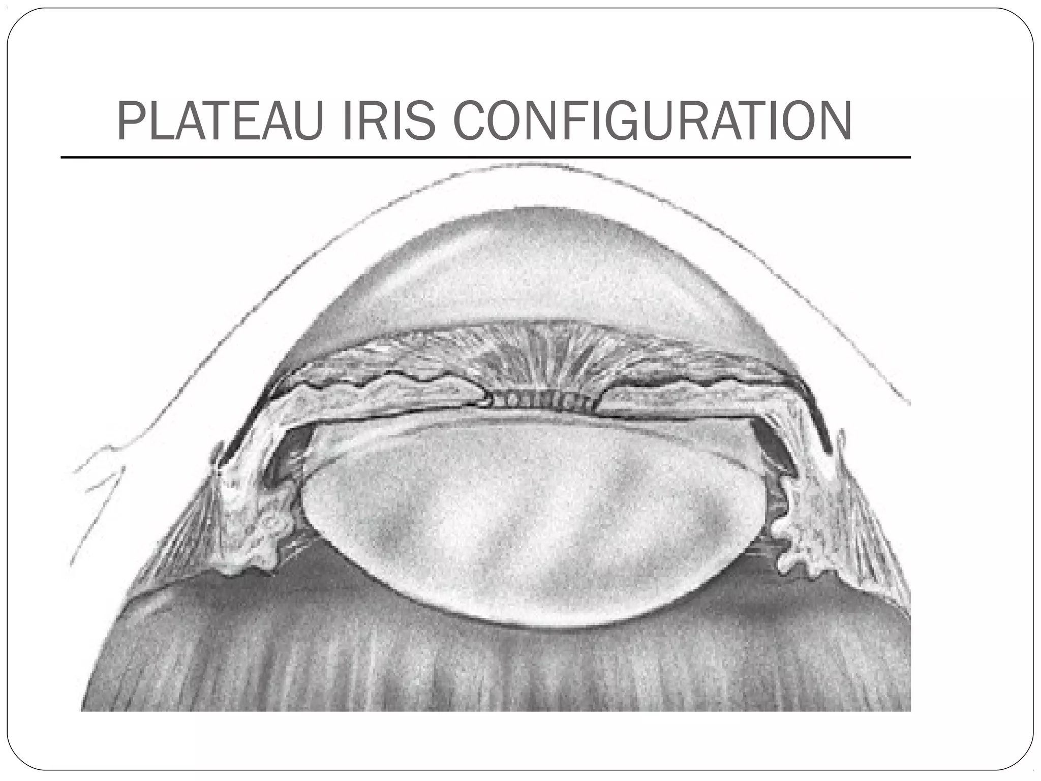 PLATEAU IRIS CONFIGURATION
 