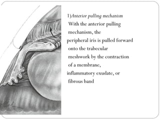 1)Anterior pulling mechanism
With the anterior pulling
mechanism, the
peripheral iris is pulled forward
onto the trabecular
meshwork by the contraction
of a membrane,
inflammatory exudate, or
fibrous band
 
