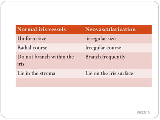 Normal iris vessels Neovascularization
Uniform size irregular size
Radial course Irregular course
Do not branch within the
iris
Branch frequently
Lie in the stroma Lie on the iris surface
08/22/15
 