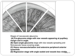 08/22/15
Stages of neovascular glaucoma.
(A) Pre-glaucoma stage with new vessels appearing at pupillary
margin and in angle.
(B) Open-angle glaucoma stage with new vessels spreading and
fibrovascular tissue covering angle.
(C) Heavy neovascularization and extensive peripheral anterior
synechiae.
(D) Regression stage with angle sealed and vessels less visible.
 