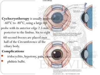 Cyclocryotherapy is usually applied at
-60°C to -80°C, using a large-tip
probe with its anterior edge 2.5 mm
posterior to the limbus. Six to eight
60-second freezes are placed over
half of the Circumference of the
ciliary body.
Complications
 iridocyclitis, hypotony, pain, cataract, and
 phthisis bulbi.
 