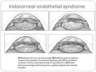 Iridocorneal endothelial syndrome
 
