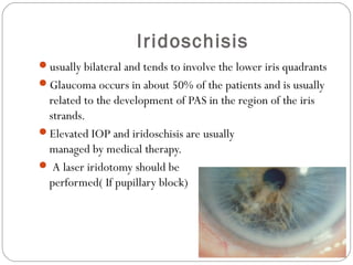 Iridoschisis
usually bilateral and tends to involve the lower iris quadrants
Glaucoma occurs in about 50% of the patients and is usually
related to the development of PAS in the region of the iris
strands.
Elevated IOP and iridoschisis are usually
managed by medical therapy.
 A laser iridotomy should be
performed( If pupillary block)
 