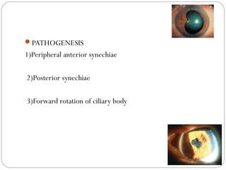 PATHOGENESIS
1)Peripheral anterior synechiae
2)Posterior synechiae
3)Forward rotation of ciliary body
 