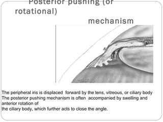 Posterior pushing (or
rotational)
mechanism
The peripheral iris is displaced forward by the lens, vitreous, or ciliary body
The posterior pushing mechanism is often accompanied by swelling and
anterior rotation of
the ciliary body, which further acts to close the angle.
 