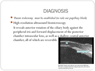 DIAGNOSIS
 Patent iridectomy must be established (to rule out pupillary block)
High-resolution ultrasound biomicroscopy
It reveals anterior rotation of the ciliary body against the
peripheral iris and forward displacement of the posterior
chamber intraocular lens, as well as a shallow central anterior
chamber, all of which are reversible
 