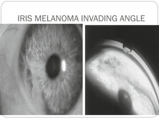 IRIS MELANOMA INVADING ANGLE
 