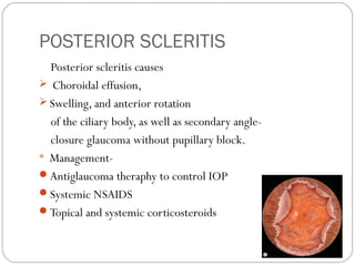 POSTERIOR SCLERITIS
Posterior scleritis causes
 Choroidal effusion,
 Swelling, and anterior rotation
of the ciliary body, as well as secondary angle-
closure glaucoma without pupillary block.

Management-
Antiglaucoma theraphy to control IOP
Systemic NSAIDS
Topical and systemic corticosteroids
 