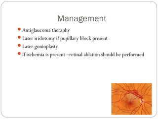 Management
Antiglaucoma theraphy
Laser iridotomy if pupillary block present
Laser gonioplasty
If ischemia is present –retinal ablation should be performed
 