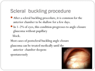 Scleral buckling procedure
After a scleral buckling procedure, it is common for the
anterior chamber to be shallow for a few days.
In 1–2% of eyes, this condition progresses to angle-closure
glaucoma without pupillary
block.
Most cases of postscleral buckling angle closure
glaucoma can be treated medically until the
anterior chamber deepens
spontaneously
 