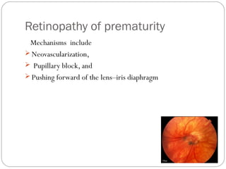 Retinopathy of prematurity
Mechanisms include
 Neovascularization,
 Pupillary block, and
 Pushing forward of the lens–iris diaphragm
 
