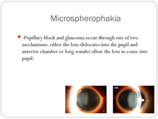 Microspherophakia
-Pupillary block and glaucoma occur through one of two
mechanisms: either the lens dislocates into the pupil and
anterior chamber or long zonules allow the lens to come into
pupil.
 