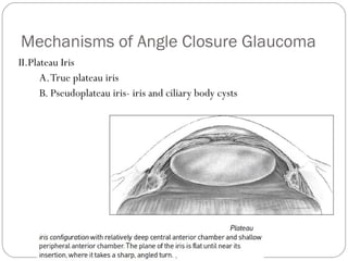 Mechanisms of Angle Closure Glaucoma
II.Plateau Iris
A.True plateau iris
B. Pseudoplateau iris- iris and ciliary body cysts
 