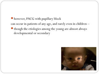 08/22/15
however, PACG with pupillary block
can occur in patients of any age, and rarely even in children –
though the etiologies among the young are almost always
developmental or secondary
 