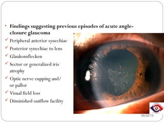 08/22/15
• Findings suggesting previous episodes of acute angle-
closure glaucoma
 Peripheral anterior synechiae
 Posterior synechiae to lens
 Glaukomflecken
 Sector or generalized iris
atrophy
 Optic nerve cupping and/
or pallor
 Visual field loss
 Diminished outflow facility
 