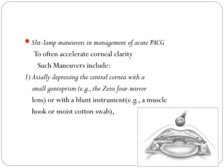 Slit-lamp maneuvers in management of acute PACG
To often accelerate corneal clarity
Such Maneuvers include:
1) Axially depressing the central cornea with a
small gonioprism (e.g.,the Zeiss four-mirror
lens) or with a blunt instrument(e.g., a muscle
hook or moist cotton swab),
 