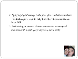 2.Applying digital massage to the globe after retrobulbar anesthesia.
This technique is used to dehydrate the vitreous cavity and
lower IOP
3. Performing an anterior chamber paracentesis,under topical
anesthesia,with a small-gauge disposable sterile needle
 