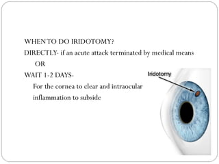 WHENTO DO IRIDOTOMY?
DIRECTLY- if an acute attack terminated by medical means
OR
WAIT 1-2 DAYS-
For the cornea to clear and intraocular
inflammation to subside
 