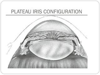 PLATEAU IRIS CONFIGURATION
 