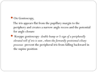 On Gonioscopy,
The iris appears flat from the pupillary margin to the
periphery and creates a narrow angle recess and the potential
for angle closure
 Koeppe gonioscopy- double hump or S-sign of a peripherally
elevated roll of iris is seen ,where the forwardly positioned ciliary
processes prevent the peripheral iris from falling backward in
the supine position
 