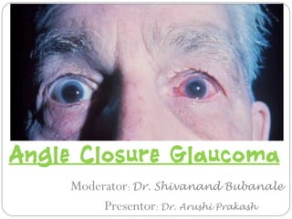 Angle Closure Glaucoma
Moderator: Dr. Shivanand Bubanale
Presentor: Dr. Arushi Prakash
 