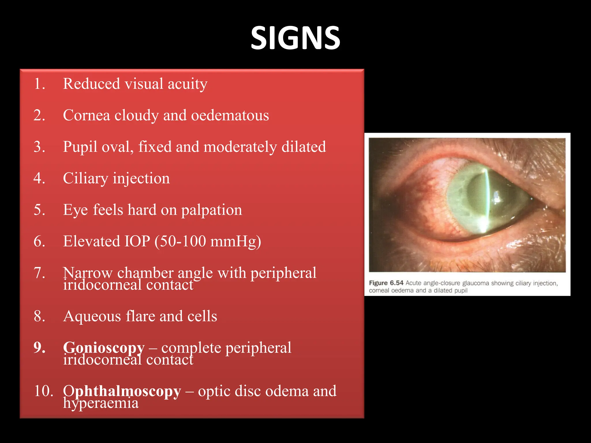 SIGNS
1. Reduced visual acuity
2. Cornea cloudy and oedematous
3. Pupil oval, fixed and moderately dilated
4. Ciliary injection
5. Eye feels hard on palpation
6. Elevated IOP (50-100 mmHg)
7. Narrow chamber angle with peripheral
iridocorneal contact
8. Aqueous flare and cells
9. Gonioscopy – complete peripheral
iridocorneal contact
10. Ophthalmoscopy – optic disc odema and
hyperaemia
 
