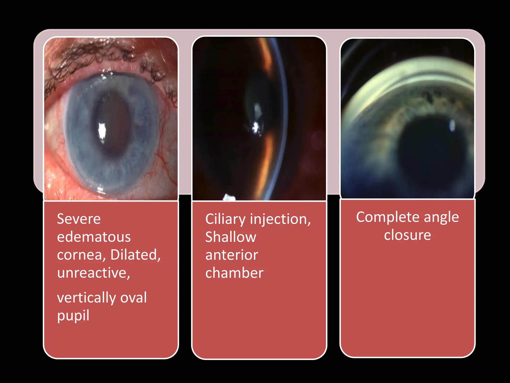 Severe
edematous
cornea, Dilated,
unreactive,
vertically oval
pupil
Ciliary injection,
Shallow
anterior
chamber
Complete angle
closure
 