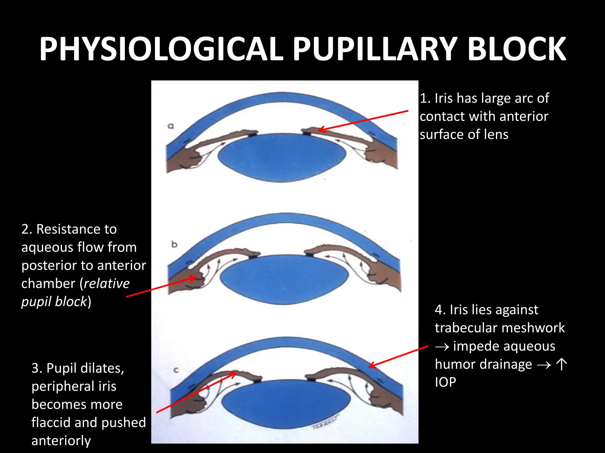 PHYSIOLOGICAL PUPILLARY BLOCK
1. Iris has large arc of
contact with anterior
surface of lens
2. Resistance to
aqueous flow from
posterior to anterior
chamber (relative
pupil block)
3. Pupil dilates,
peripheral iris
becomes more
flaccid and pushed
anteriorly
4. Iris lies against
trabecular meshwork
 impede aqueous
humor drainage  ↑
IOP
 