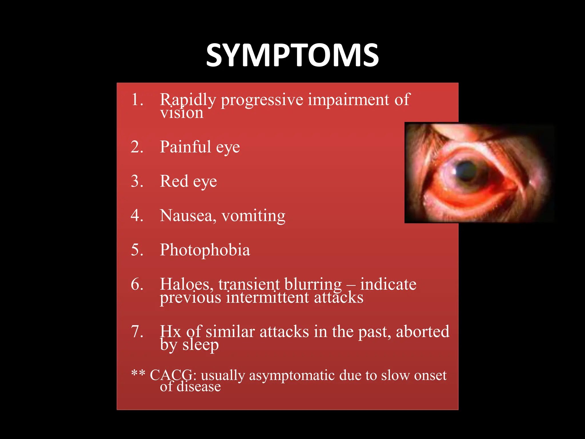 SYMPTOMS
1. Rapidly progressive impairment of
vision
2. Painful eye
3. Red eye
4. Nausea, vomiting
5. Photophobia
6. Haloes, transient blurring – indicate
previous intermittent attacks
7. Hx of similar attacks in the past, aborted
by sleep
** CACG: usually asymptomatic due to slow onset
of disease
 