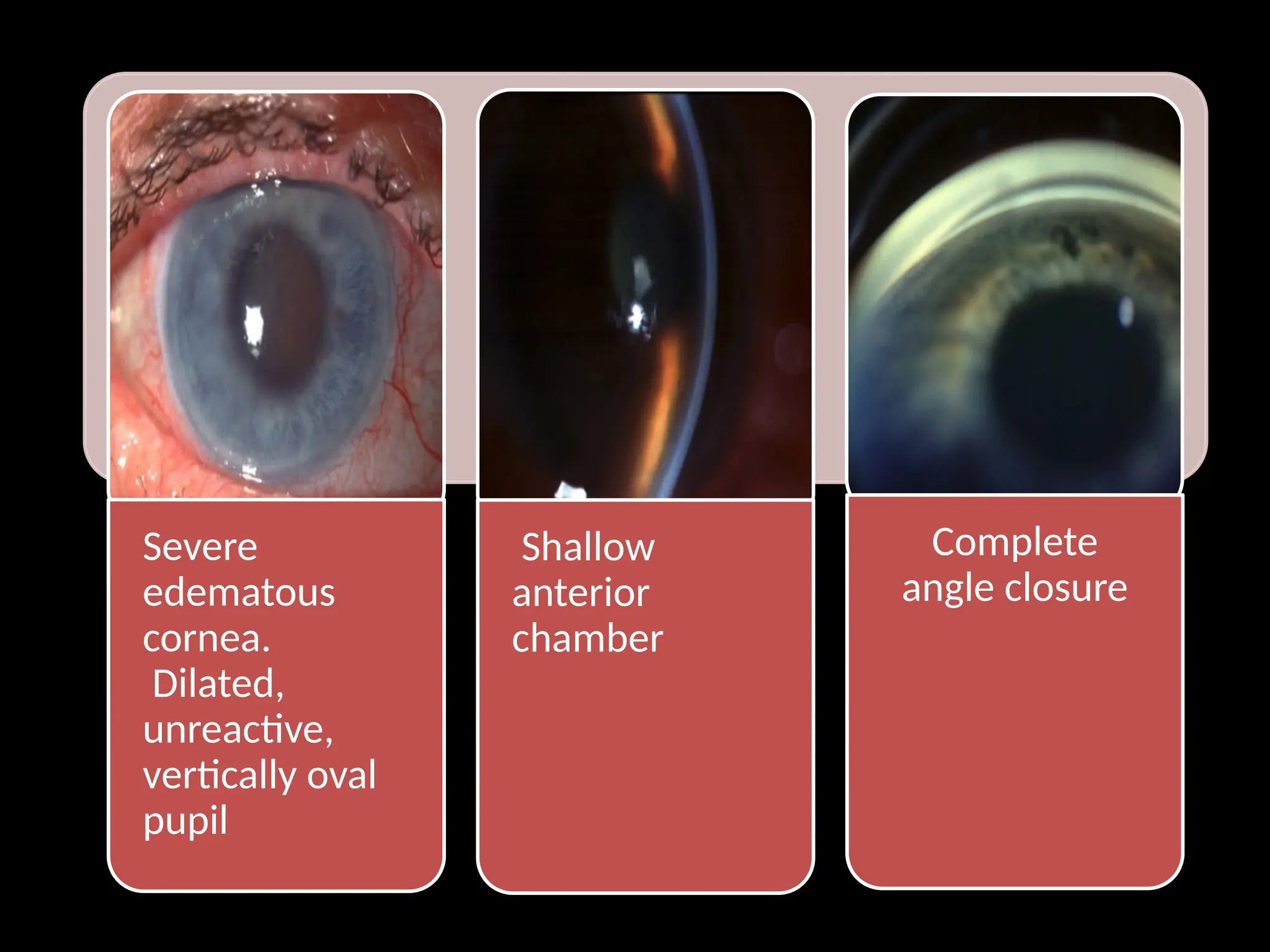 Severe
edematous
cornea.
Dilated,
unreactive,
vertically oval
pupil
Shallow
anterior
chamber
Complete
angle closure
 
