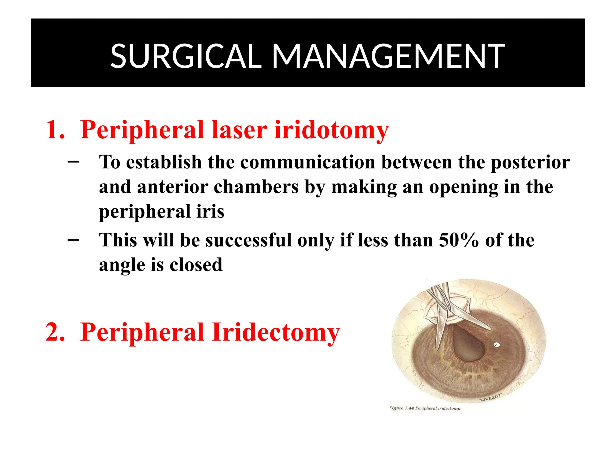 SURGICAL MANAGEMENT
1. Peripheral laser iridotomy
– To establish the communication between the posterior
and anterior chambers by making an opening in the
peripheral iris
– This will be successful only if less than 50% of the
angle is closed
2. Peripheral Iridectomy
 