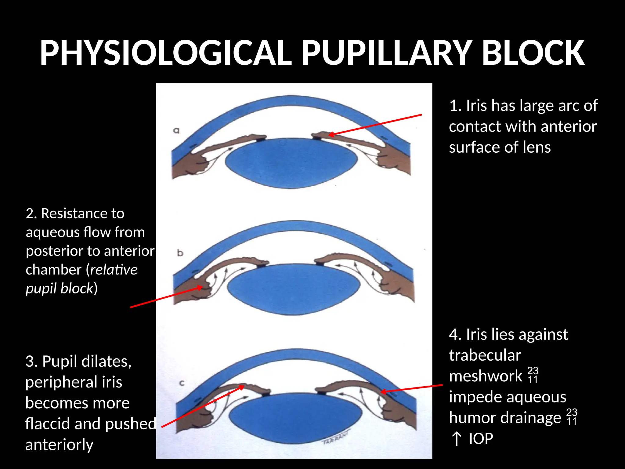 PHYSIOLOGICAL PUPILLARY BLOCK
1. Iris has large arc of
contact with anterior
surface of lens
2. Resistance to
aqueous flow from
posterior to anterior
chamber (relative
pupil block)
3. Pupil dilates,
peripheral iris
becomes more
flaccid and pushed
anteriorly
4. Iris lies against
trabecular
meshwork 
impede aqueous
humor drainage 
↑ IOP
 