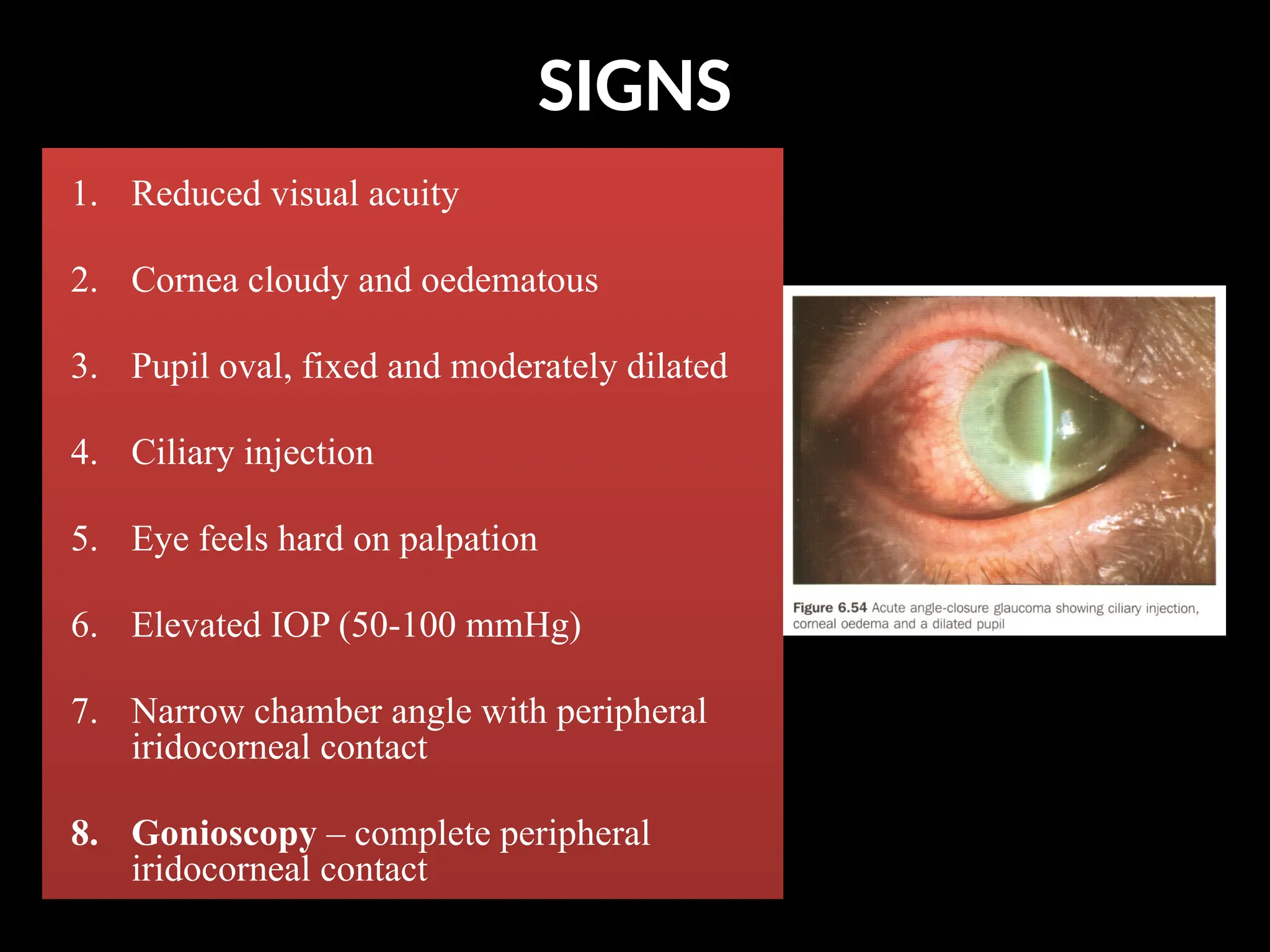 SIGNS
1. Reduced visual acuity
2. Cornea cloudy and oedematous
3. Pupil oval, fixed and moderately dilated
4. Ciliary injection
5. Eye feels hard on palpation
6. Elevated IOP (50-100 mmHg)
7. Narrow chamber angle with peripheral
iridocorneal contact
8. Gonioscopy – complete peripheral
iridocorneal contact
 