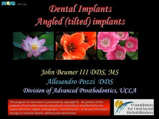 Dental Implants
Angled (tilted) implants
John Beumer III DDS, MS
Allesandro Pozzi DDS
Division of Advanced Prosthodontics, UCLA
This	
  program	
  of	
  instruc1on	
  is	
  protected	
  by	
  copyright	
  ©.	
  	
  No	
  por1on	
  of	
  this	
  
program	
  of	
  instruc1on	
  may	
  be	
  reproduced,	
  recorded	
  or	
  transferred	
  by	
  any	
  
means	
  electronic,	
  digital,	
  photographic,	
  mechanical	
  etc.,	
  or	
  by	
  any	
  informa1on	
  
storage	
  or	
  retrieval	
  system,	
  without	
  prior	
  permission.	
  
 