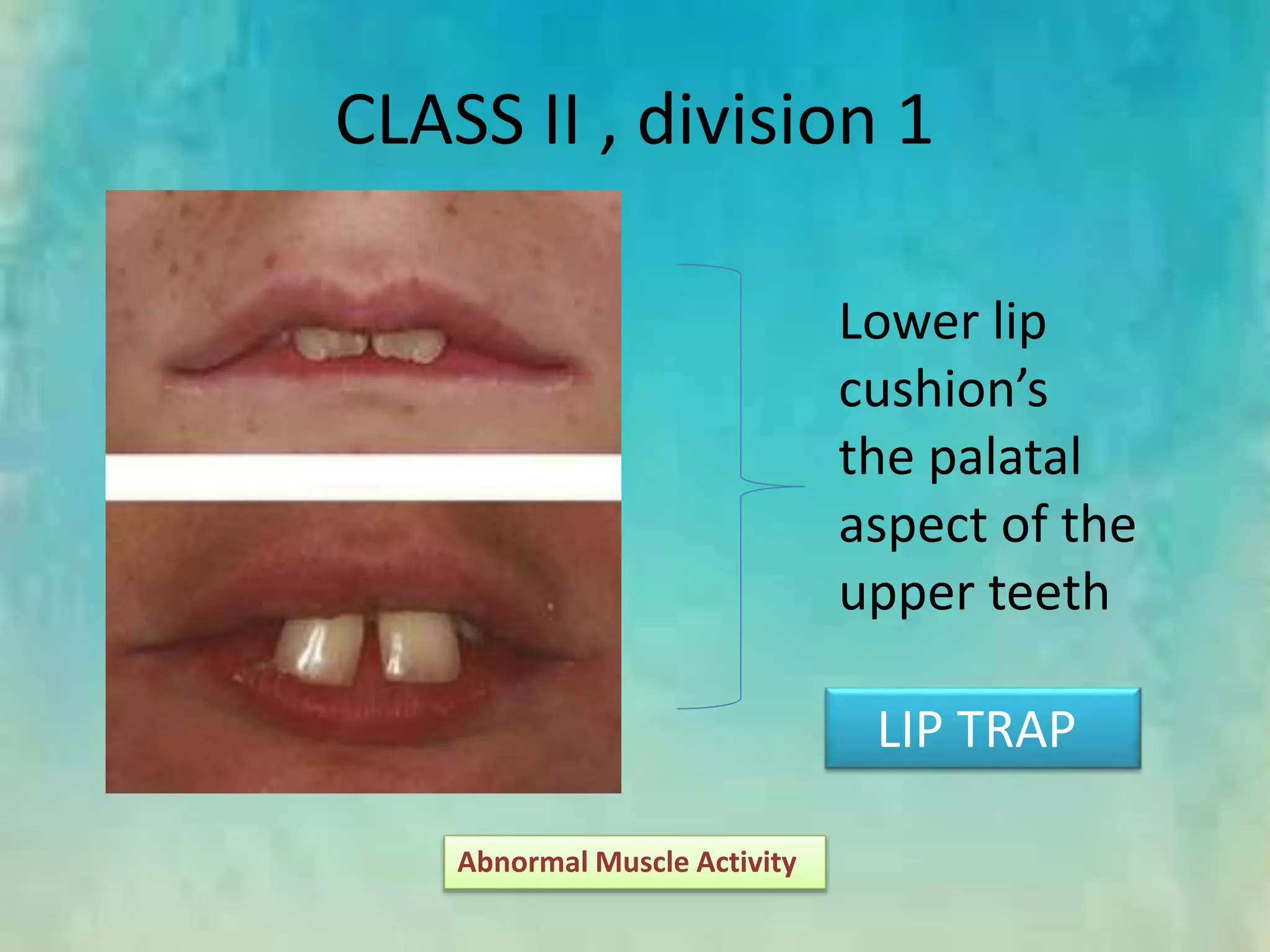 CLASS II , division 1
Abnormal Muscle Activity
Lower lip
cushion’s
the palatal
aspect of the
upper teeth
LIP TRAP