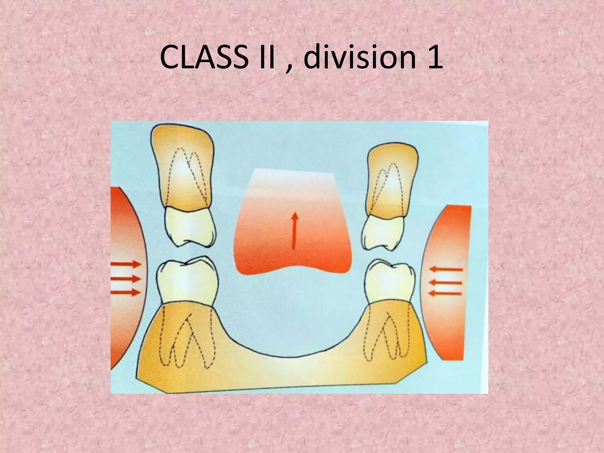 CLASS II , division 1