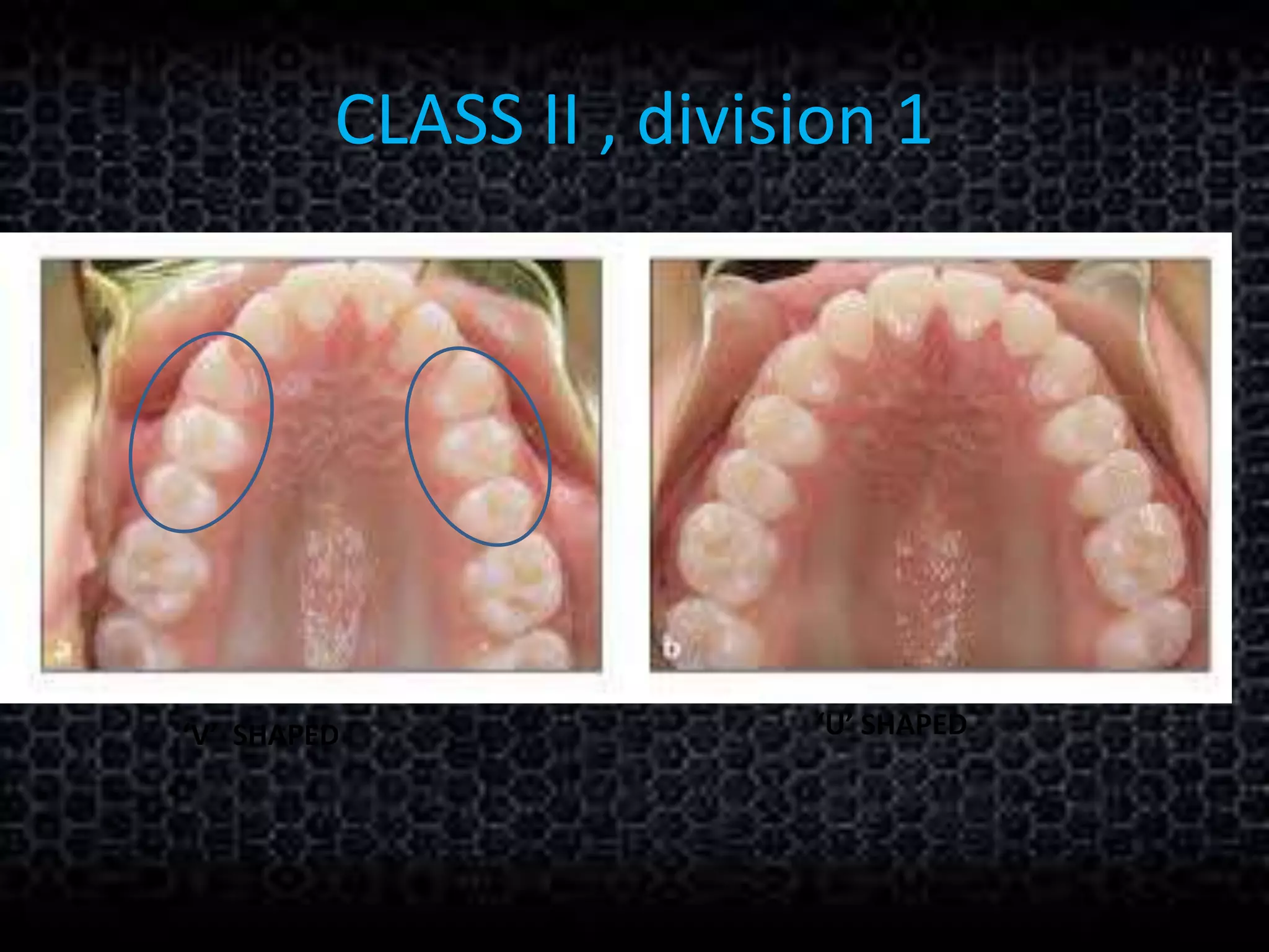 CLASS II , division 1
‘V’ SHAPED ‘U’ SHAPED