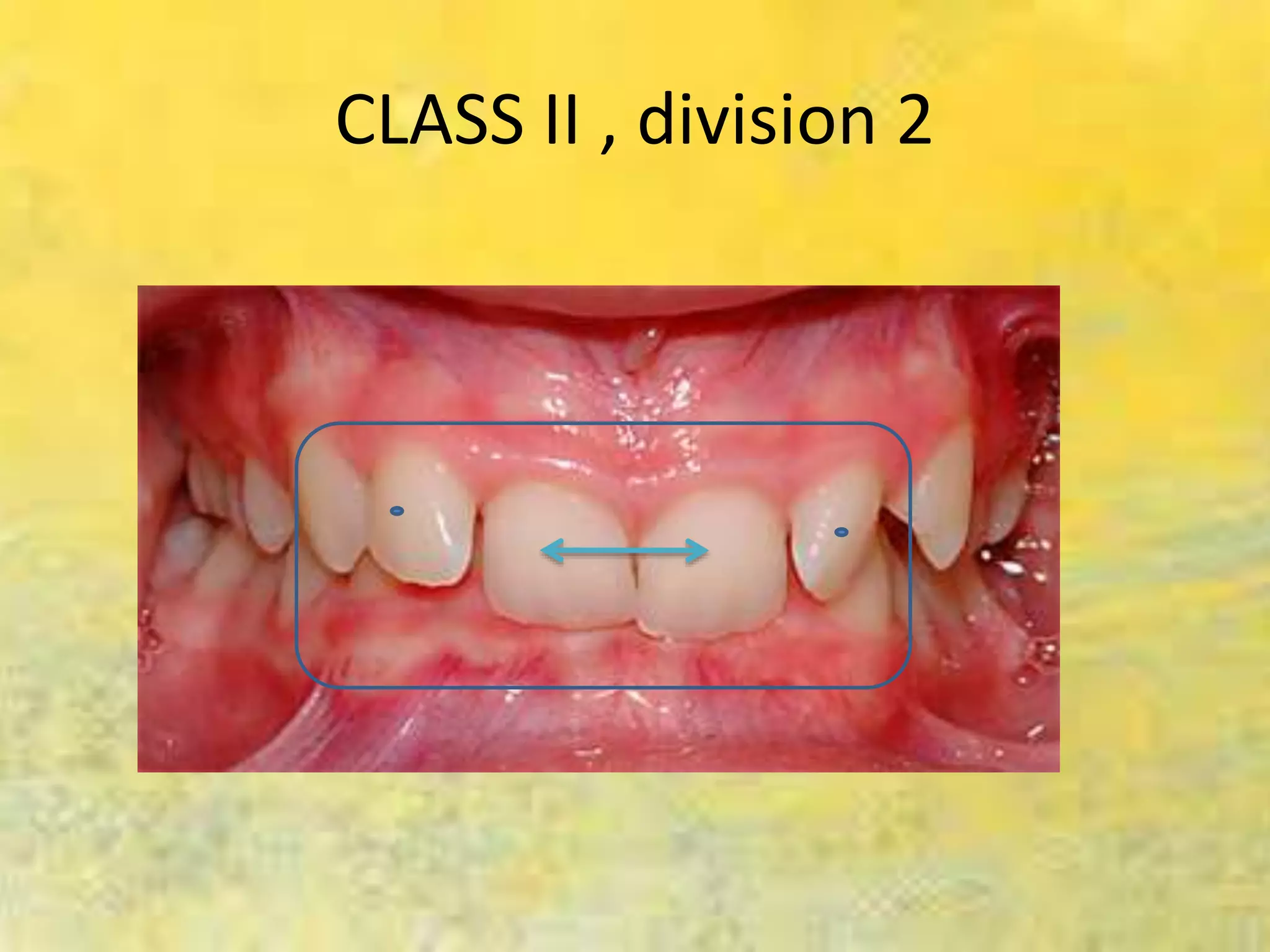 CLASS II , division 2