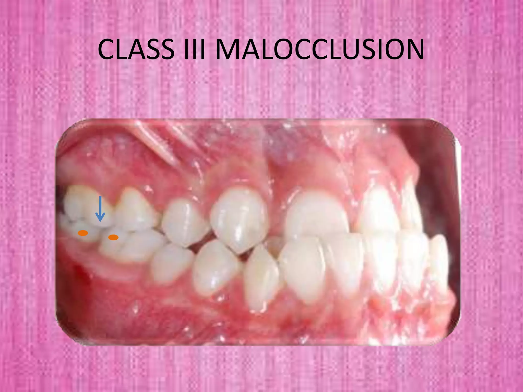 CLASS III MALOCCLUSION