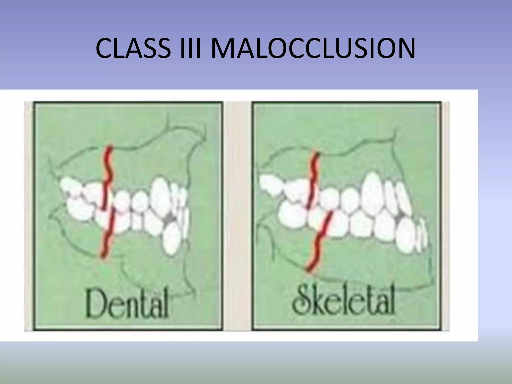 CLASS III MALOCCLUSION