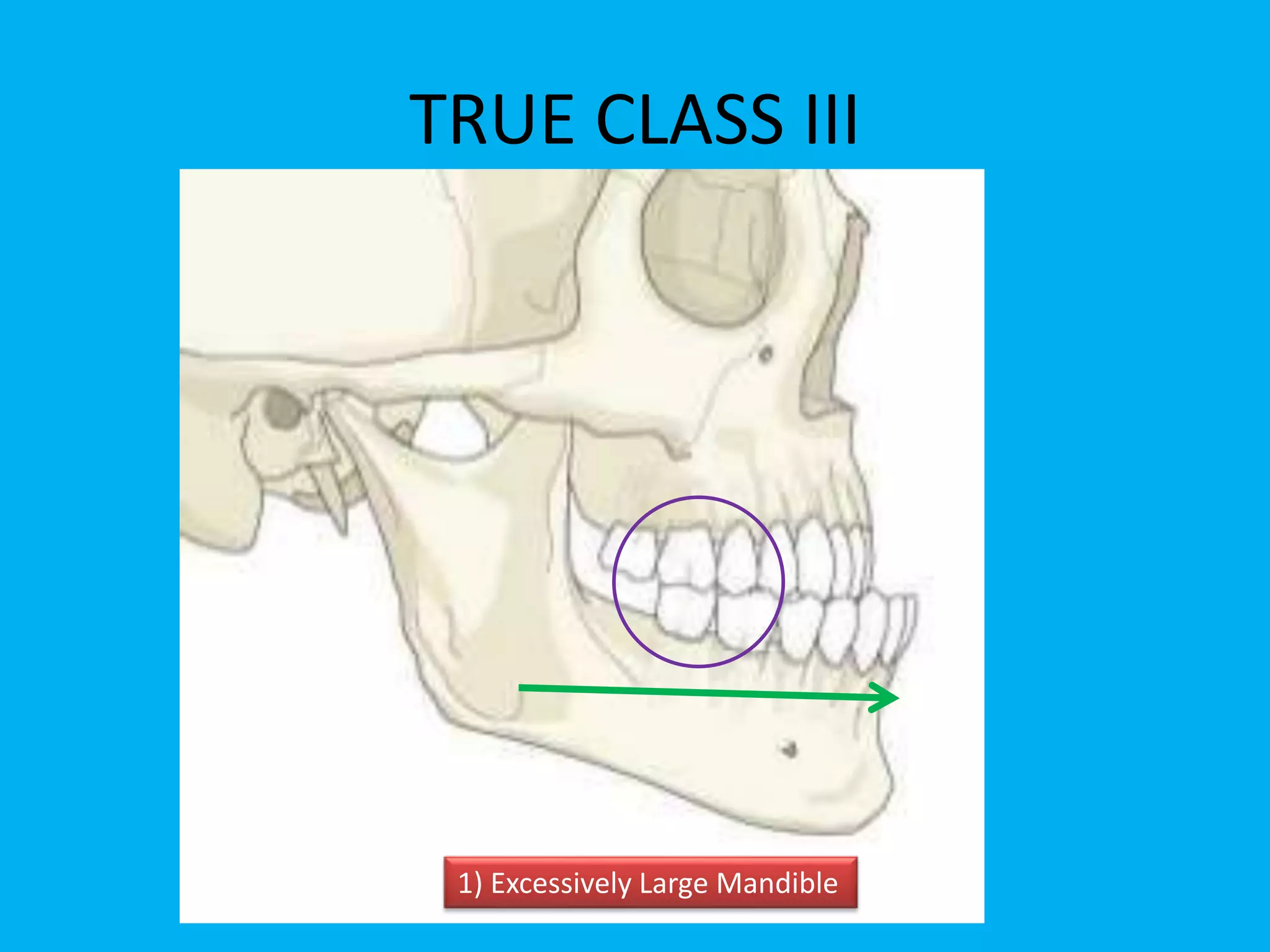 1) Excessively Large Mandible
TRUE CLASS III