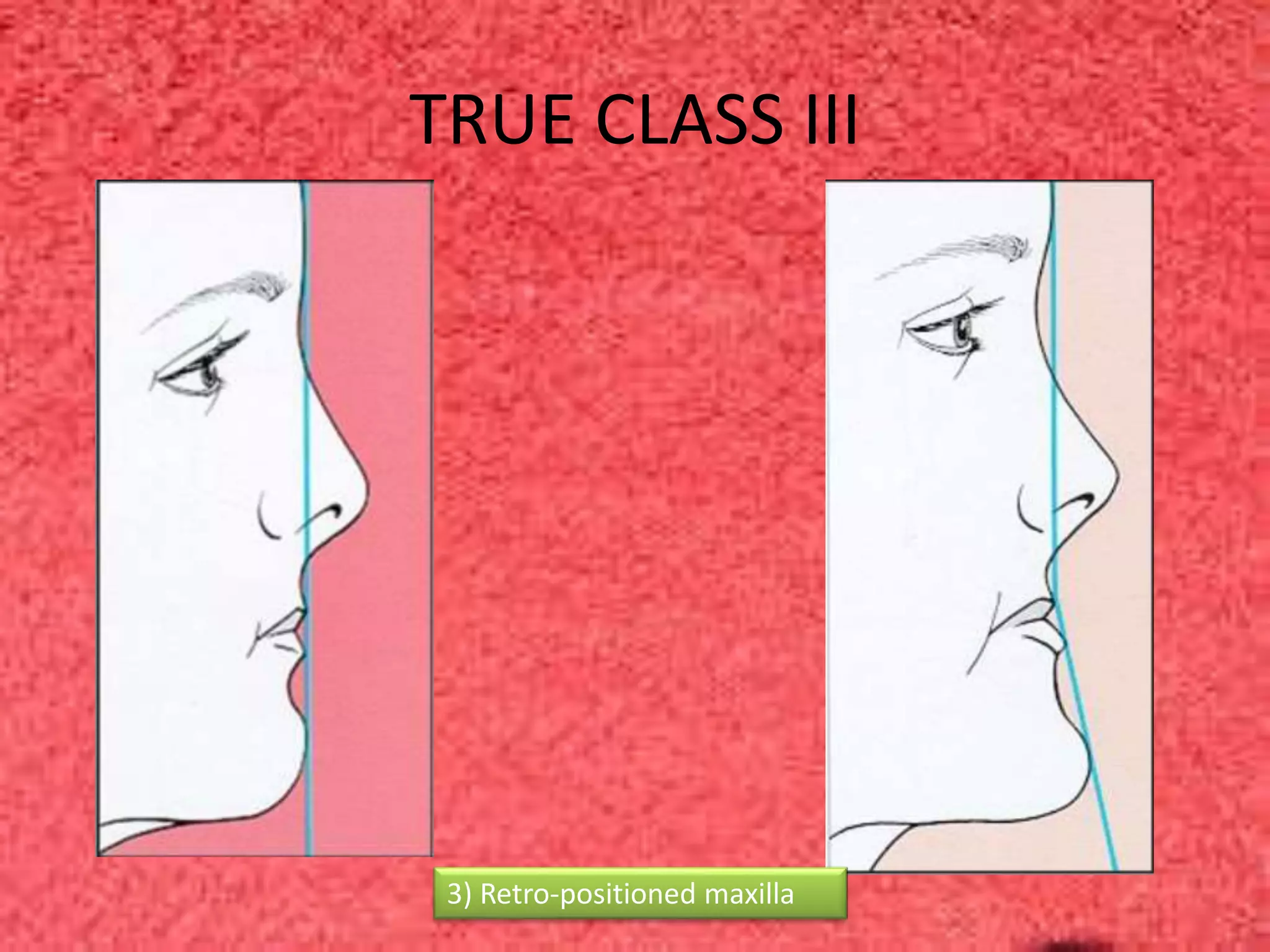 3) Retro-positioned maxilla
TRUE CLASS III