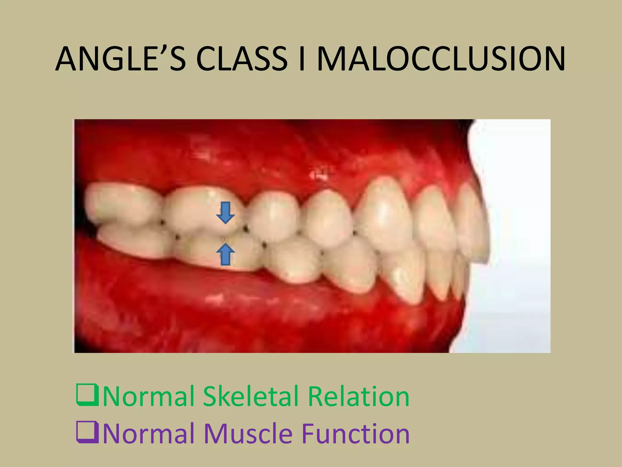 ANGLE’S CLASS I MALOCCLUSION
Normal Skeletal Relation
Normal Muscle Function